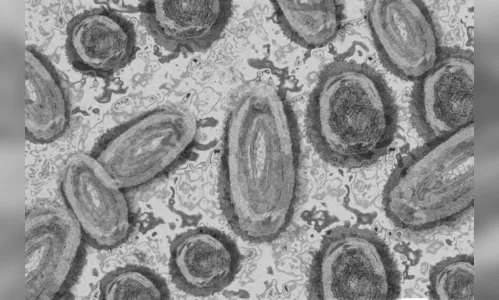 Arapongas confirma caso de Monkeypox; Paraná tem 299 infectados