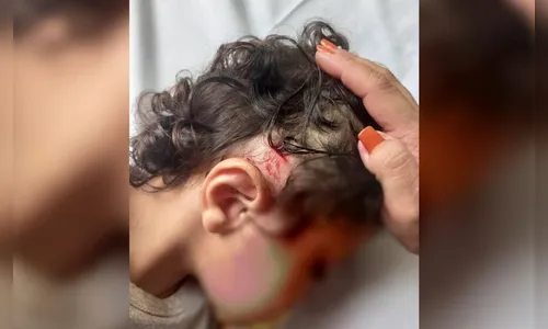 Ventilador de teto cai e causa ferimentos em cabeça de criança