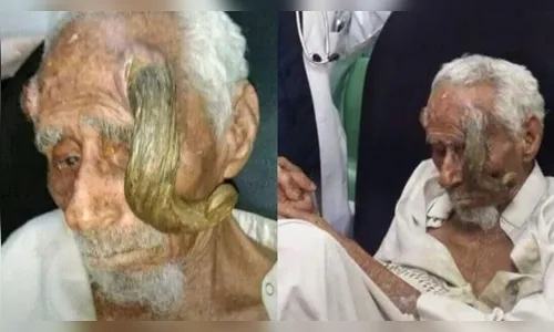Homem que dizia ter 140 anos morre após cirurgia para tirar 'chifres'