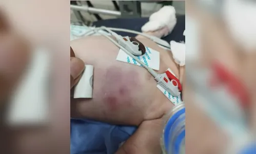 Bebê que teve costela quebrada após agressão recebe alta da UTI
