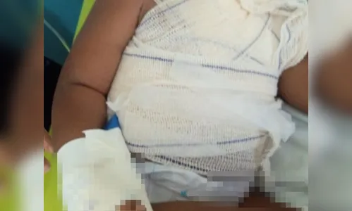 Criança derruba panela com óleo quente e sofre ferimentos graves no PR