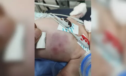 Casal é indiciado por tentativa de homicídio contra bebê de 17 dias