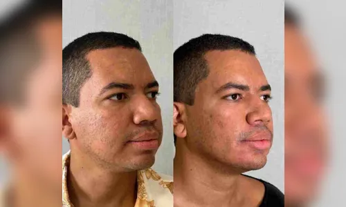 Bruno Gaga se manifesta após polêmica sobre harmonização facial