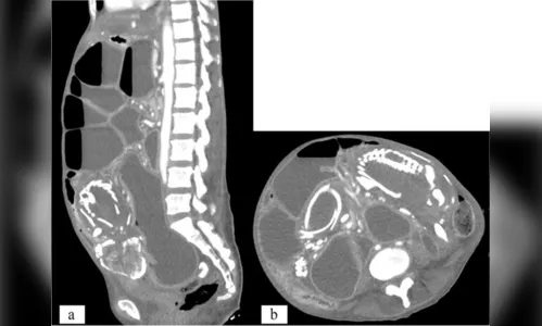 Mulher morre após carregar feto calcificado no intestino por nove anos
