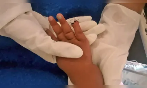 Bebê tem dedo amputado após erro na hora de tirar atadura no RJ