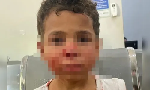 Pitbull invade casa, mata cachorro e morde rosto de criança em Goiás