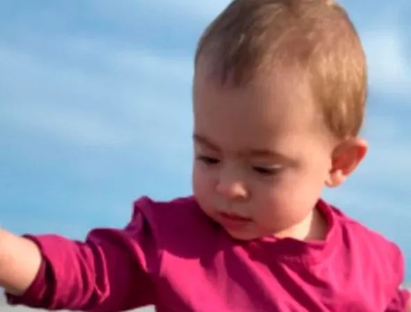 Emília tem 1 ano e foi diagnosticada com cranioestenose do tipo trigonocefalia