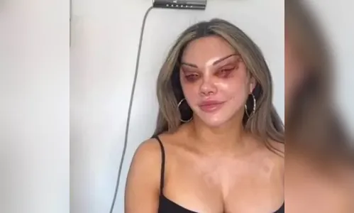 Mulher faz plástica para ter 'olhos de gato' e tem rosto deformado