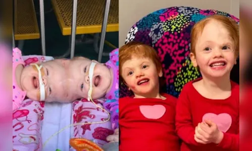 Siamesas que tinham 2% de chance de sobreviver se formam na pré-escola