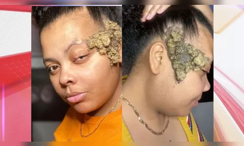 Mulher descobre síndrome rara após marca de nascença crescer demais