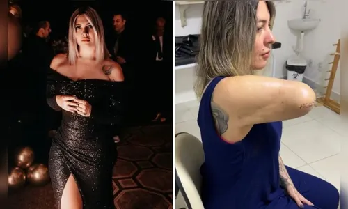 Tatuadora realiza procedimento estético e por erro médico perde braço