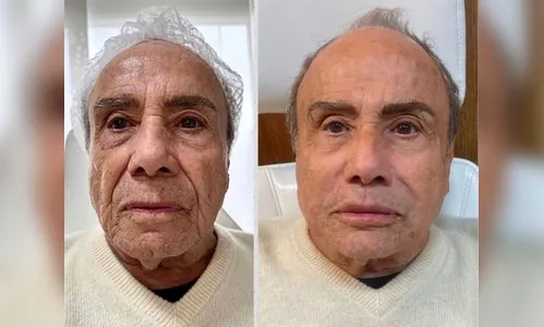 Stênio Garcia rebate críticas após fazer harmonização aos 91 anos