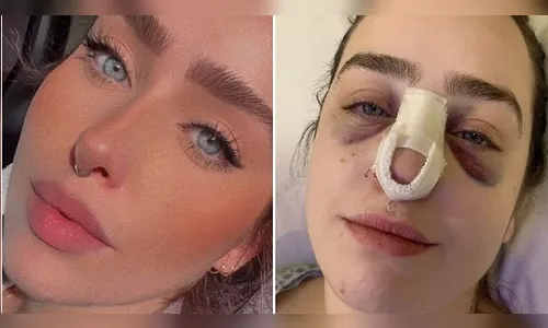 Nutricionista leva cabeçada de homem e precisa passar por cirurgia