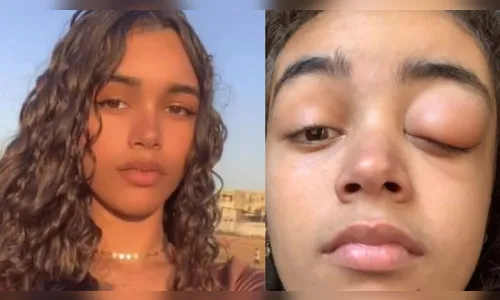 Jovem retira parte do crânio e quase fica cega por causa de sinusite