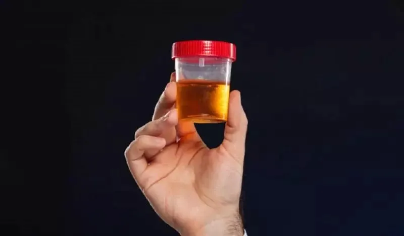Cor da urina pode revelar problemas