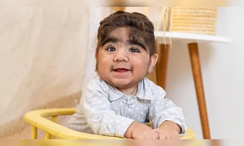 Bebê peludo faz sucesso na internet; conheça sua condição genética