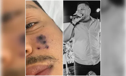 Cantor de forró morre após ser picado por aranha no rosto