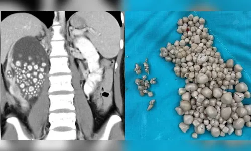 Médicos retiram mais de 300 pedras do rim de jovem que não tomava água