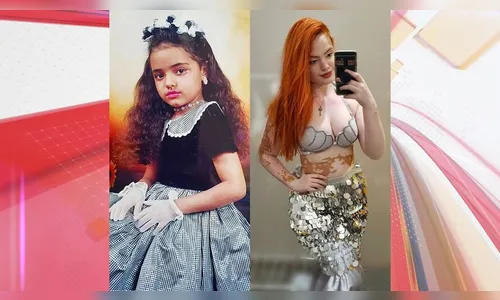 Apucaranense com vitiligo viraliza ao afirmar não se considerar branca