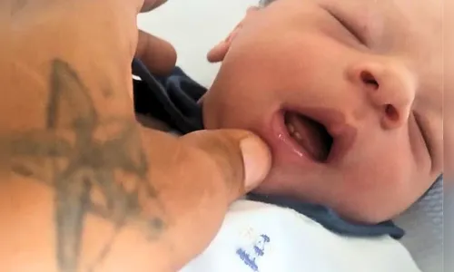 Bebê com condição rara nasce com dentes e surpreende equipe de saúde