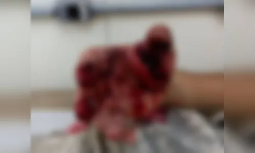 GM tem mão dilacerada ao acionar bomba achando que era rastreador