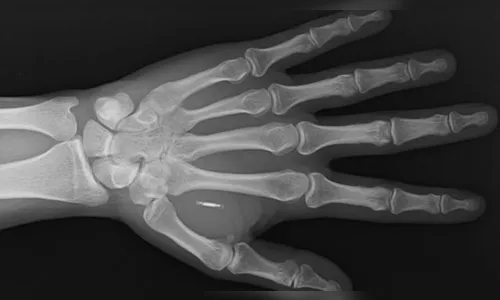 Por qual motivo humanos estão implantando chips no próprio corpo?