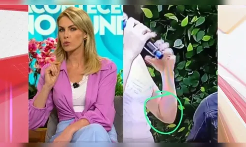 Ana Hickmann exibe hematoma causado pelo marido pela primeira vez
