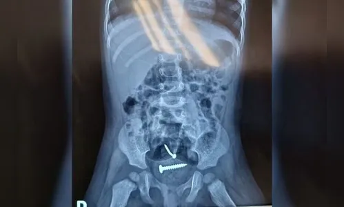 Parafusos são encontrados dentro de menina de 1 ano estuprada pelo pai