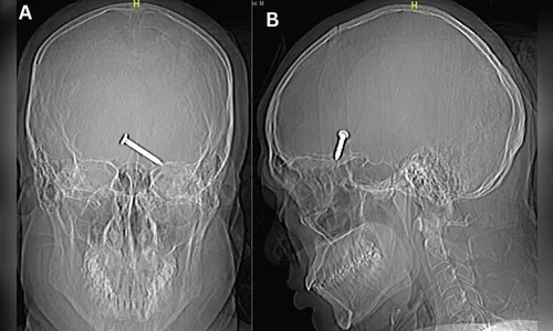 Homem atira prego no próprio olho e projétil vai parar no cérebro