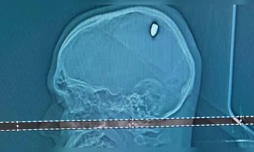 Jovem levou tiro no réveillon e descobriu bala na cabeça após 4 dias