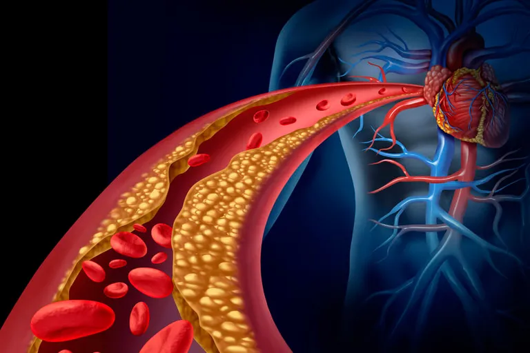 Presentes em níveis elevados no sangue, o colesterol ruim pode fazer com que a gordura se aloje nas paredes internas das artérias