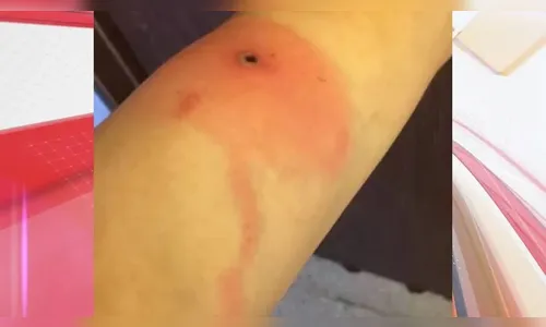 Dor ardente e lesões no corpo: o que se sabe sobre varíola do Alasca?