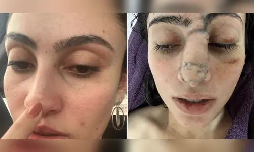 Empresária descobre câncer raro ao tentar tirar sinal no nariz