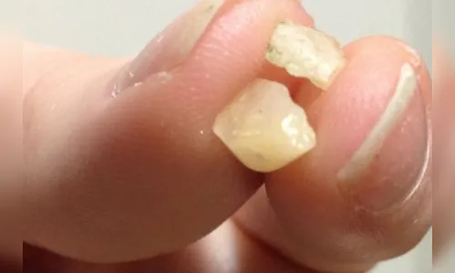 Homem tenta engolir drogas para não ser preso em Kaloré