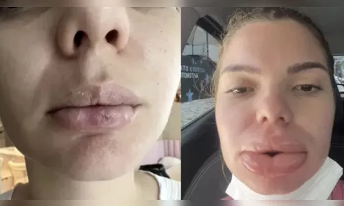 Nutricionista tem necrose labial após preenchimento malsucedido
