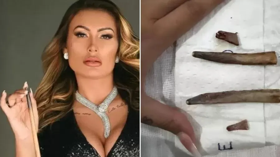 Andressa Urach mostrou costelas retiradas após cirurgia