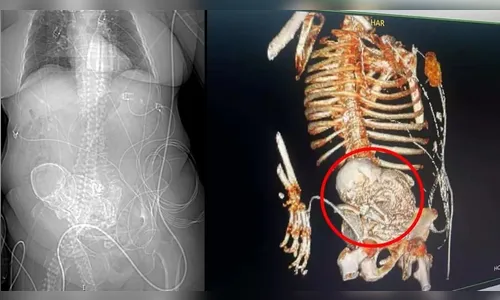 Idosa sente dores e descobre que carregou 