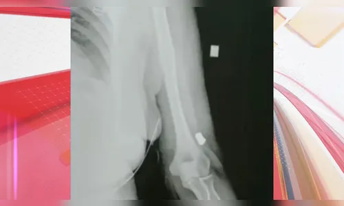 Mulher sente dores tomando sorvete e descobre bala perdida no braço