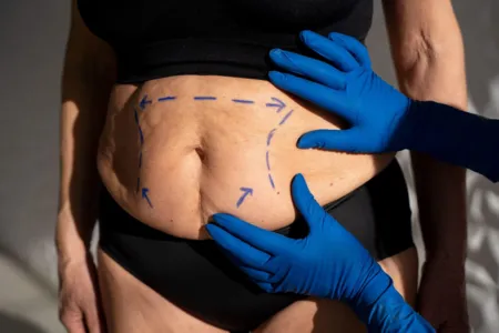 Cirurgião explica cirurgia para retirar excesso de tecido do abdômen