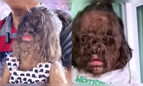 Vídeo de menina com 'síndrome do Lobisomem' viraliza na web; confira