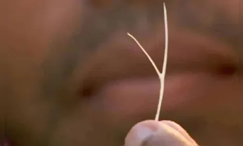 Mulher engasgada com espinha de peixe causa tumulto em hospital