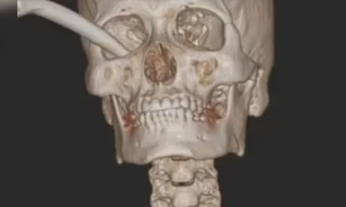 Freio de moto fica fincado em olho de jovem após grave acidente