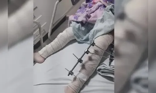 Médicos operam perna errada de criança e toda a equipe é afastada