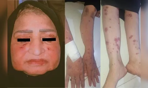 Alergia grave: mulher chora lágrimas de pus após tomar ibuprofeno