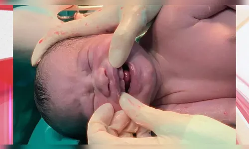 Bebê nasce com seis dentes e surpreende a família