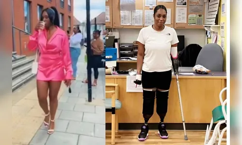 Mulher tem braço e pernas amputados após dar à luz a gêmeos; entenda