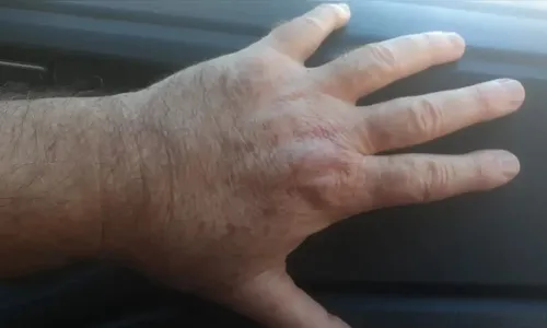 Estudo reduz riscos do tratamento contra leishmaniose cutânea