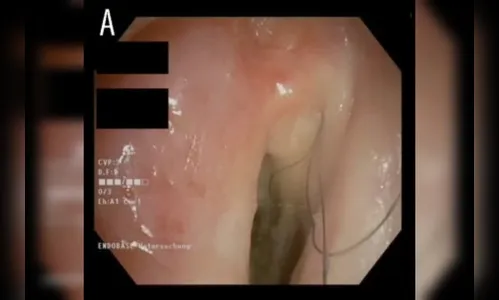 Cabelos crescem na garganta de homem que fumava 20 cigarros por dia