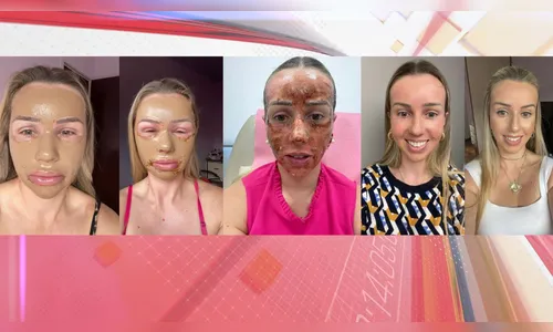 Peeling de Fenol: nutricionista de Apucarana conta experiência