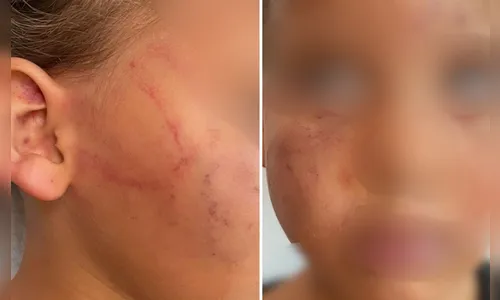 Menina faz xixi na roupa e é mordida e espancada pela mãe